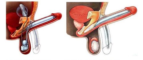 Prótese de pene con prótese inflável (esquerda) e de plástico (dereita)
