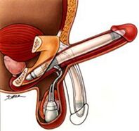 Implantes de ampliación do pene para homes